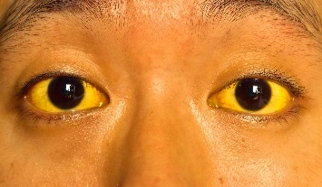  Icterícia (coloração amarelada da pele e dos olhos)