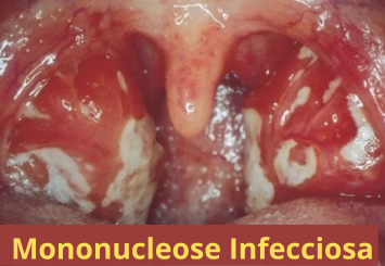 A Mononucleose Infecciosa é uma doença viral comum, geralmente causada pelo vírus Epstein-Barr (EBV