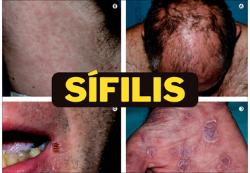 A sífilis é uma doença sexualmente transmissível (DST) causada pela bactéria Treponema pallidum
