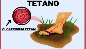 O tétano é uma doença infecciosa causada pela bactéria Clostridium tetani.